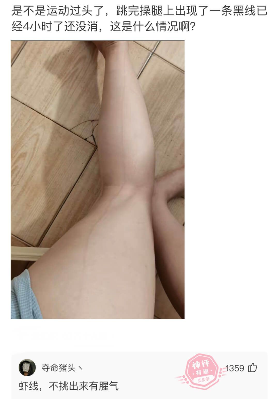 是不是运动过头了，跳完操腿上出现了一条黑线已经4小时了还没消