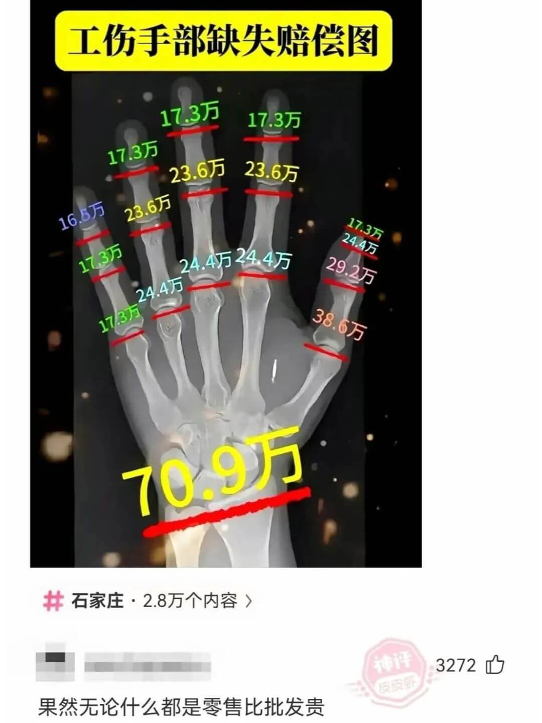 工伤手部缺失赔偿图17.3万17.3万17.3万23.6万2