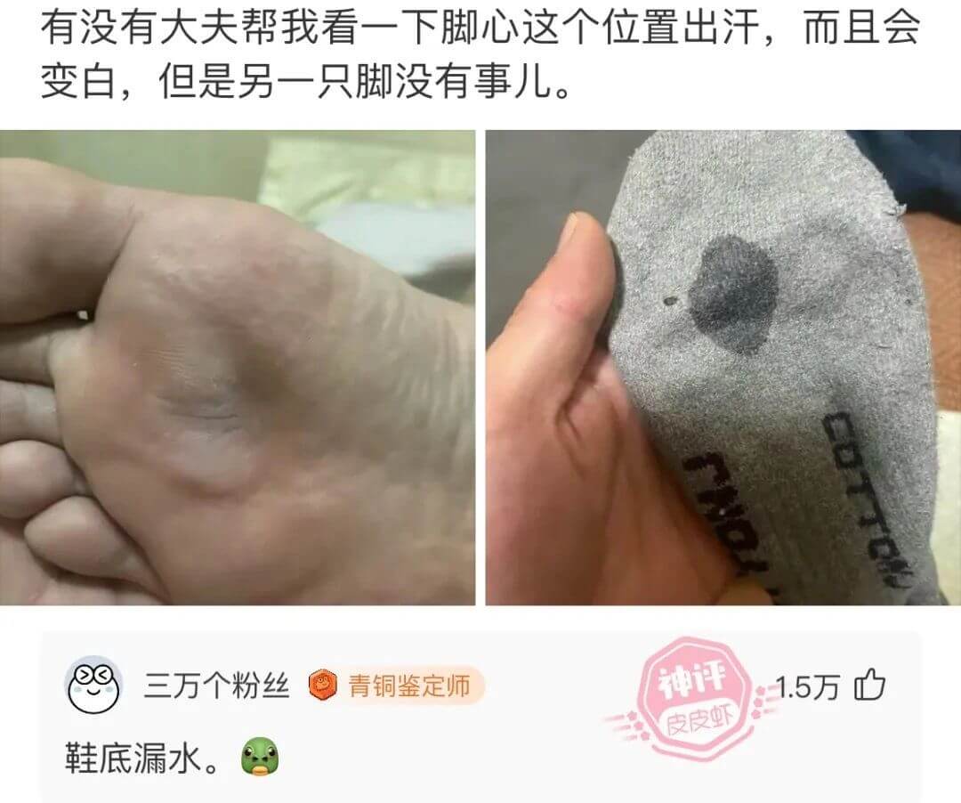 有没有大夫帮我看一下脚心这个位置出汗，而且会变白，但是另一只