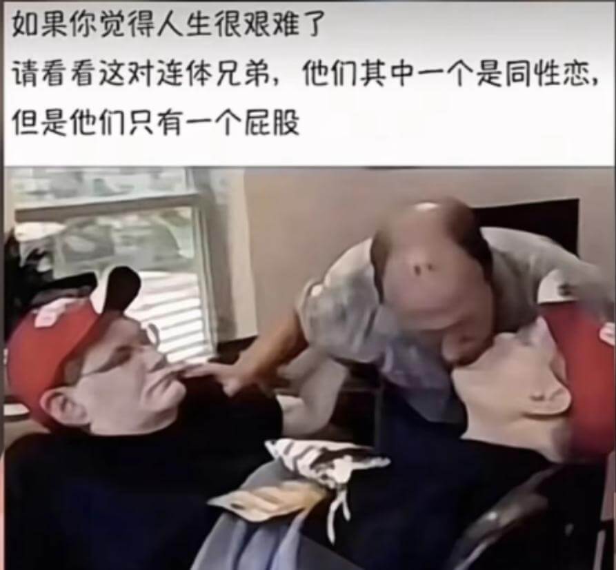 如果你觉得人生很艰难了，请看看这对连体兄弟，他们其中一个是同