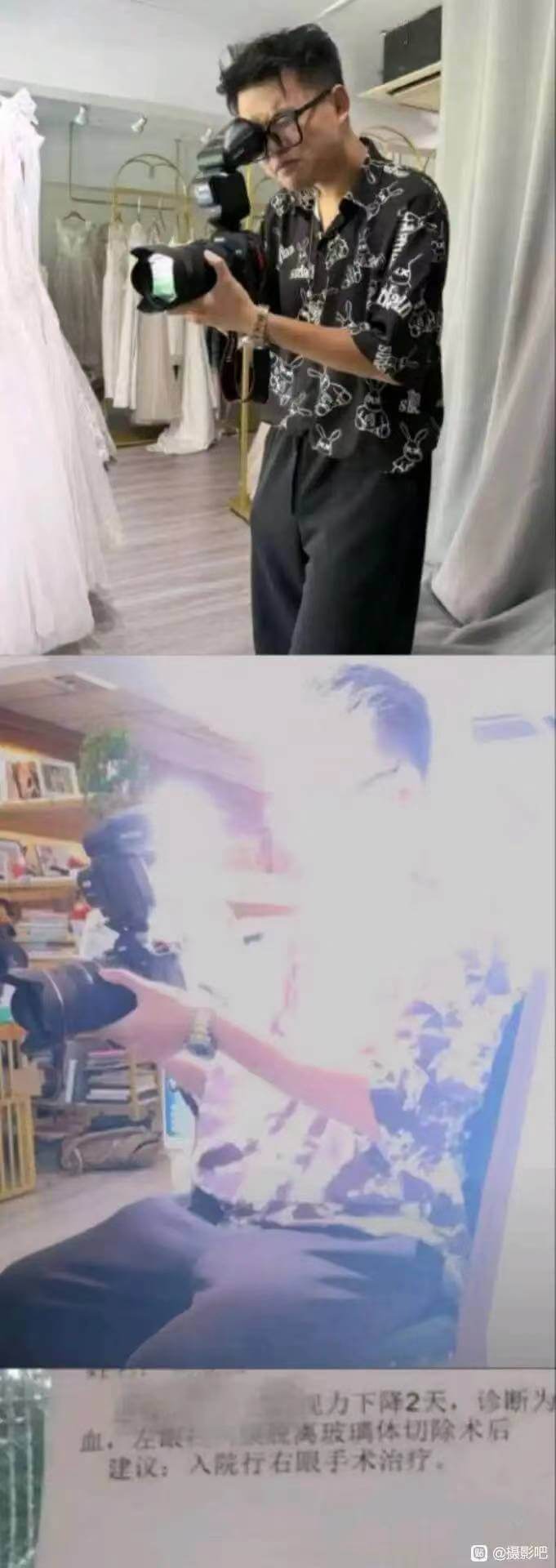 见力下降2天，诊断为脱高玻璃体切除术后出血，在款建汉：入院行