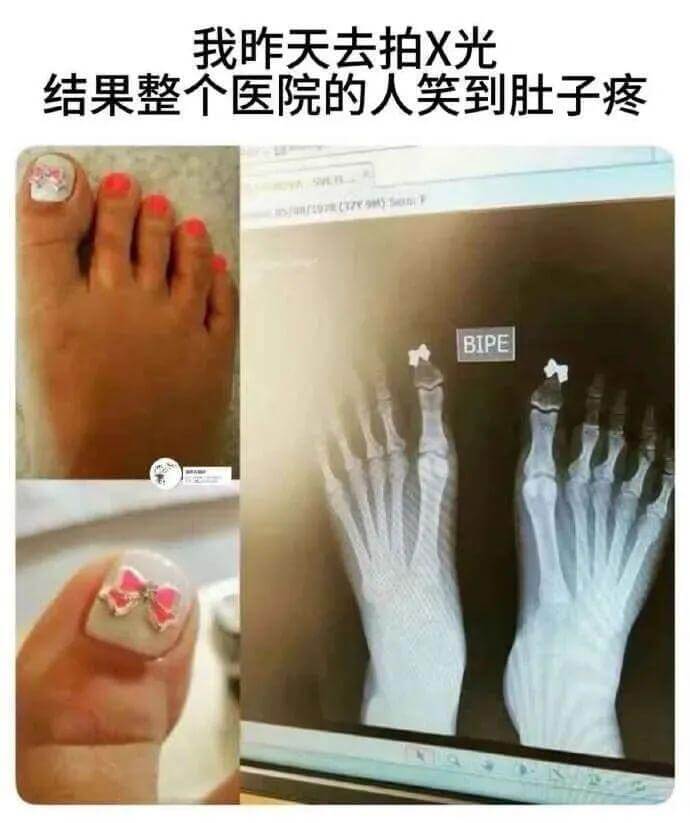 我昨天去拍X光，结果整个医院的人笑到肚子疼。BIPE