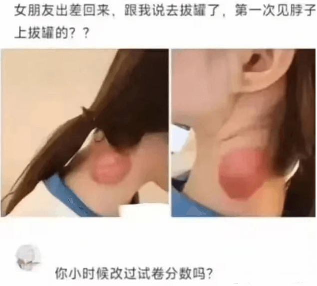 女朋友出差回来跟我说去拔罐了，第一次见脖子上拔罐的？？你小时