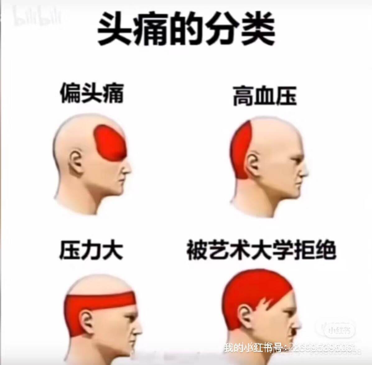 头痛的分类偏头痛高血压压力大被艺术大学拒绝我的小红书号：66