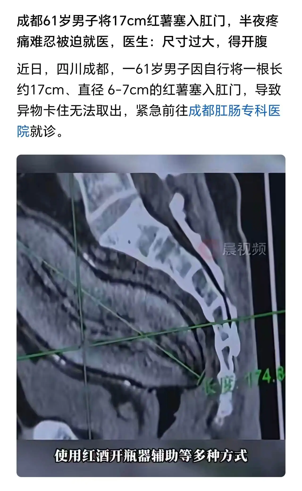成都61岁男子将17cm红薯塞入肛门,半夜疼痛难忍被迫就医,
