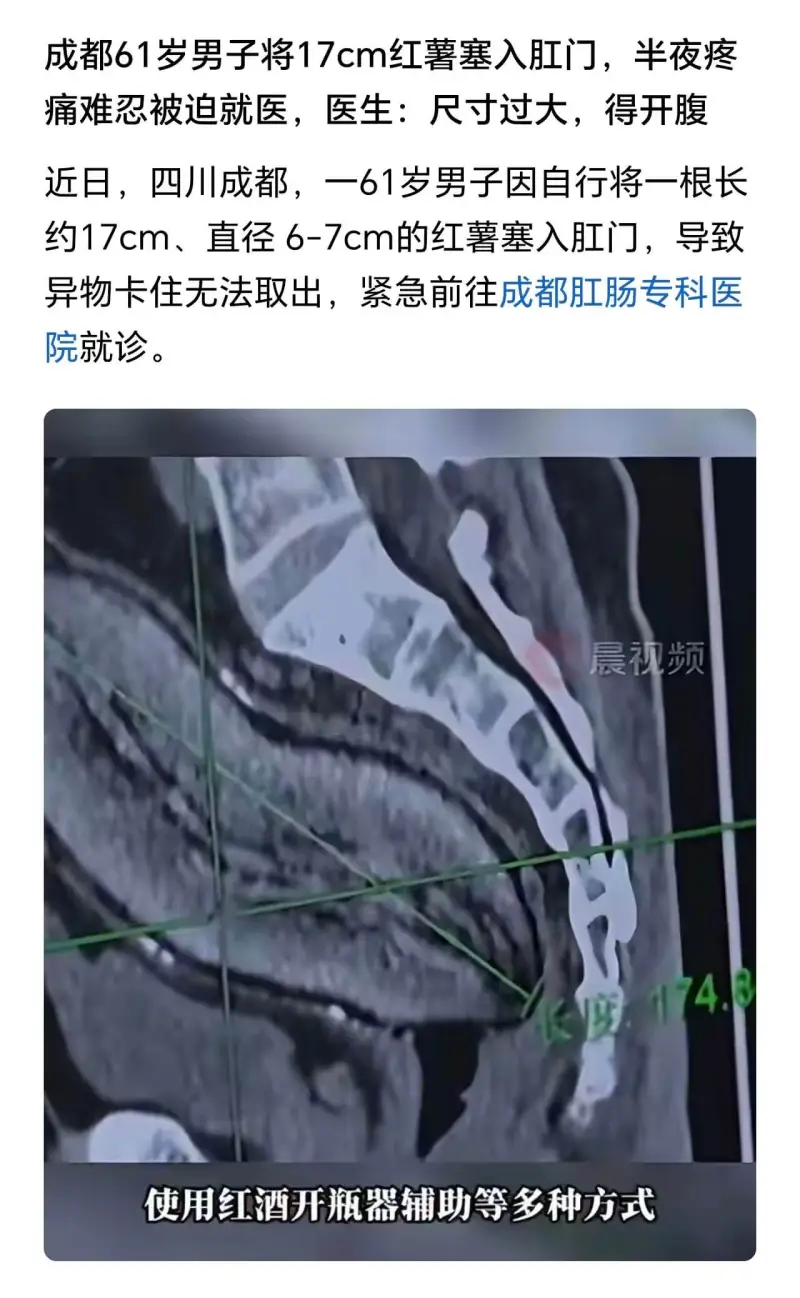 成都61岁男子将17cm红薯塞入肛门，半夜疼痛难忍被迫就医，