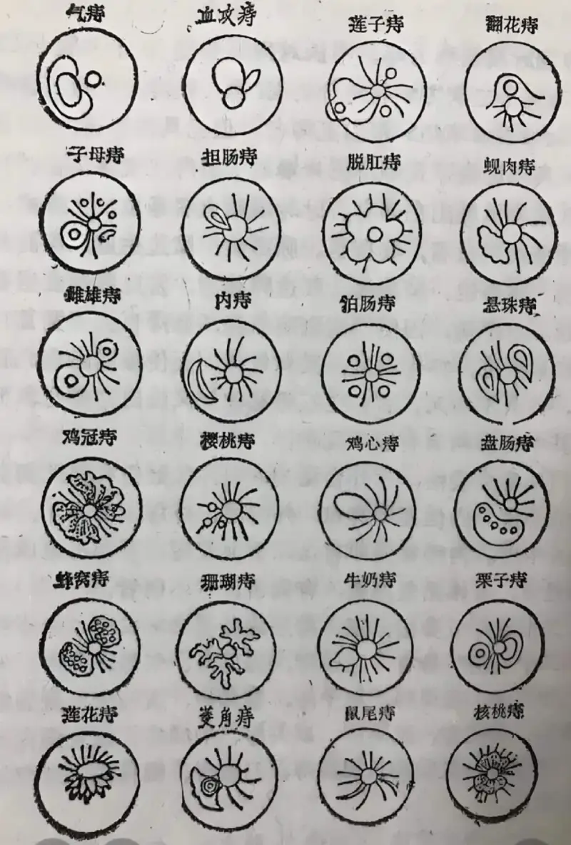 气痣莲子痔翻花痔子母痔担肠痔脱肛痔蚬肉痔雕雄痔内痔泊肠痔悬珠