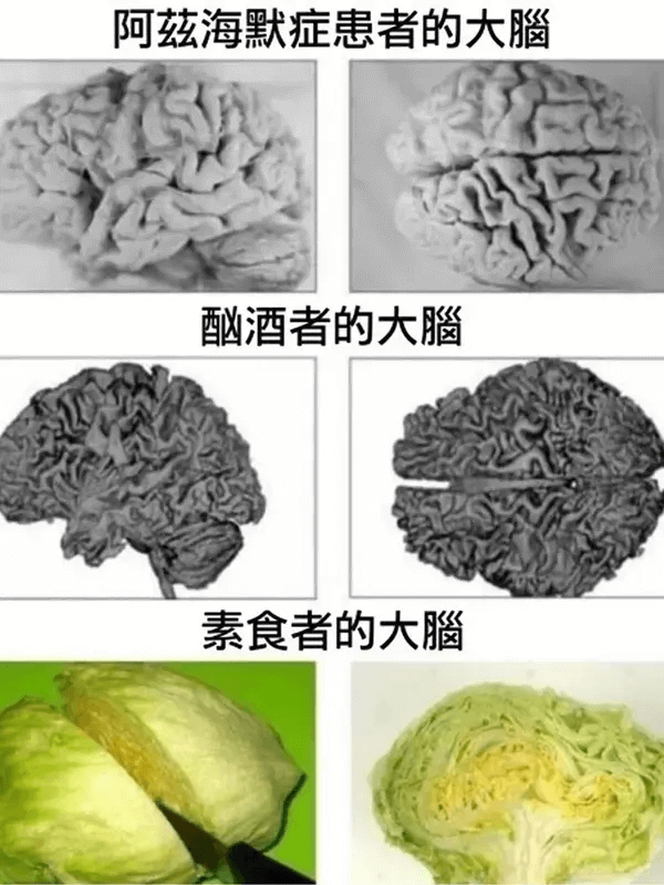 阿兹海默症患者的大脑酗酒者的大脑素食者的大胸